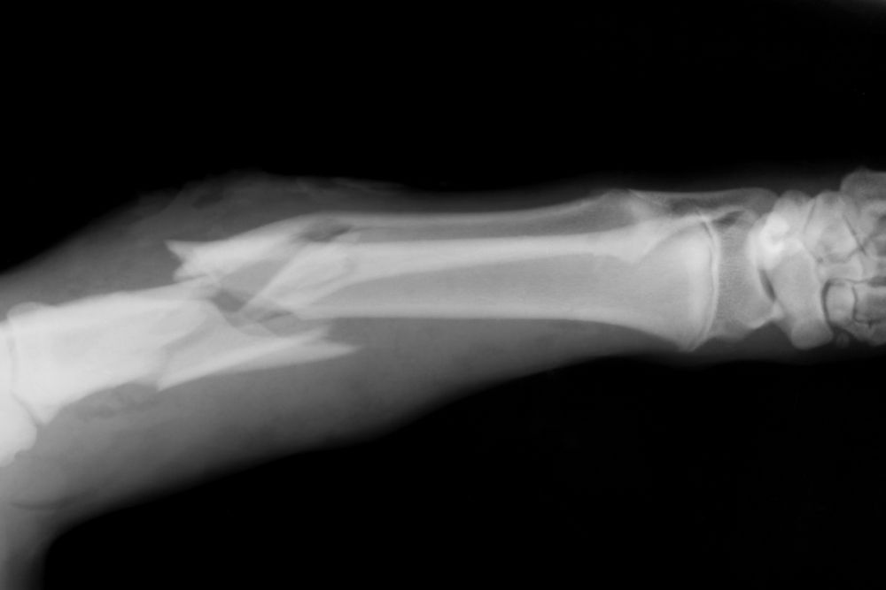 What Are The Most Common Causes Of Broken Bone Cases